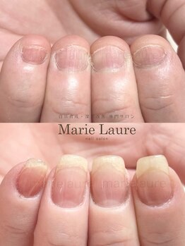 マリーロール 淀屋橋本店(Marie Laure)/自爪育成/深爪矯正/ネイルケア