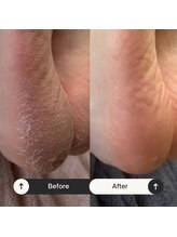 マオヌー(MAONU)/式足裏角質ケア　症例写真