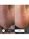 式足裏角質ケア 症例写真