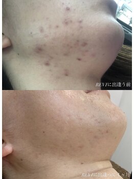 ムム(mumu)/敏感肌/繰り返すニキビ改善/毛穴