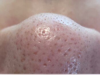 リセットプラス(Reset+)/お鼻の産毛目立っていませんか？