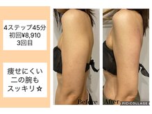 ハピネス(HAPPINESS)/4ステップメニュー　二の腕3回目