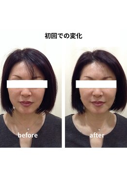 かがりの整骨院 鍼灸院/鍼灸/美容鍼/小顔