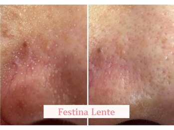 フェスティナ レンテ(Festina Lente)の写真/[トルネード毛穴洗浄*ハイドロスキン]肌表面に蓄積した皮脂や汚れ/毛穴の詰まり/黒ずみ/角栓/古い角質に◎