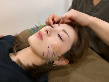 アラキ(ARAKI)の写真/美容鍼で硬くなった筋肉をほぐし、シワたるみ改善◎[美容鍼×電気]でワンランク上のリフトアップが叶う♪