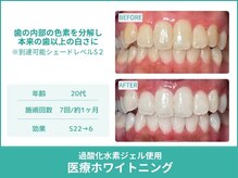 クレア(Crea)/【歯のホワイトニング症例写真】