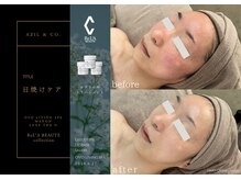 オーヴォ リビングスパ アネックス マノン(OVO LIVING SPA annex MANON)/【施術事例】日焼けケア