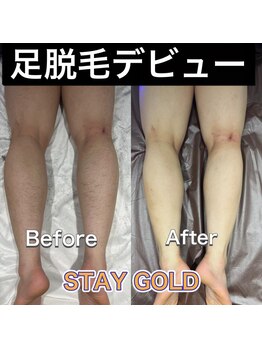 ステイゴールド 新百合ヶ丘(STAY GOLD)/ひざ裏ってかいてしまいますよね