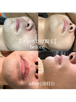 サロン リタ(Salon Rita)/メンズひげ脱毛☆