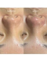 スピカ(Spica)/毛穴エクストラクション