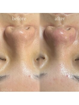 スピカ(Spica)/毛穴エクストラクション