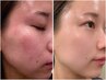 肌質改善カウンセリング♪メニューに迷われている方はこちらでご予約ください