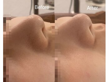 リアン(Lien)/毛穴洗浄ハイドロスプラッシュ