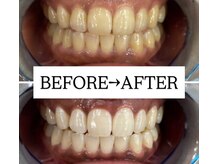 ホワイトニングサロン 宝塚/Before&After美白ホワイトニング