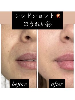 チャルム(CAL'ME)/レッドショット ほうれい線