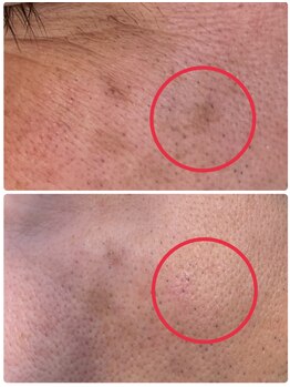 シミ・たるみケア専門店Labo荒尾大牟田【光フェイシャル/プラズマ/毛穴洗浄/韓国WAX】/光フェイシャル/シミ