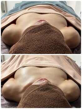 ルミエール(Lumiere)/【倉敷市】バストアップ施術事例