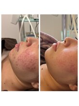 マリヴェリーテ(Mari verite)/20代、ニキビ、赤み悩み改善