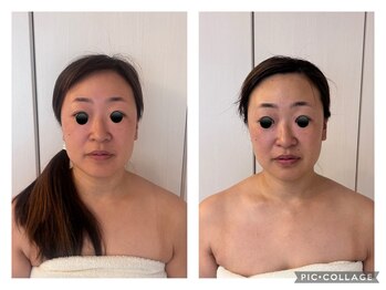 ハートエルボー(Heart elbow)/立体的な小顔で若見え効果