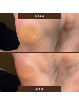 マオヌー(MAONU)/韓国式足裏角質ケア　症例写真