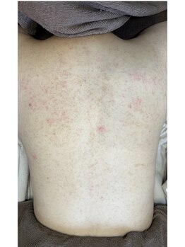 ウィズサロン(withサロン)/背中お悩みハーブピーリング