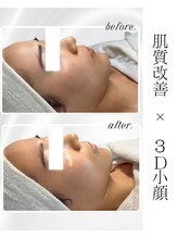 リアム(LiAm)/ララピール×レモンボトル