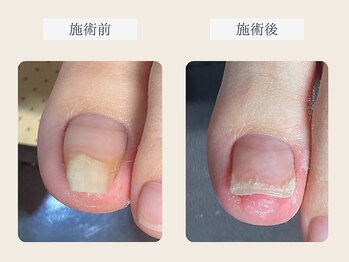 ルポ 伊勢/巻き爪ケア