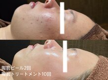 ディアーム 光明池店(Diarm)/REVIトリートメント&ピール