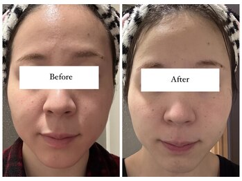 ジョーヌ(JAUNE)/ホームケアでも肌質改善