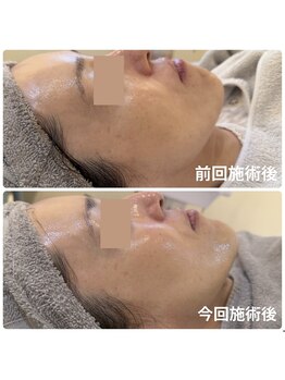 【医療提携】毛穴・たるみ・美肌育成専門店　緒々one＋【チョチョワンプラス】/美肌更新中！