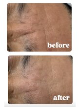 ナルフロウ(nalufurou)/RED SHOTプラズマ導入♪