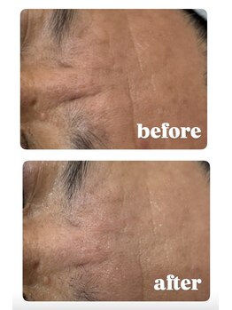 ナルフロウ(nalufurou)/RED SHOTプラズマ導入♪