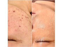 エッセンシア(ESSENCIA)の雰囲気(剥離なし◎肌に優しいハーブピールで透明感とキメのあるお肌へ♪)