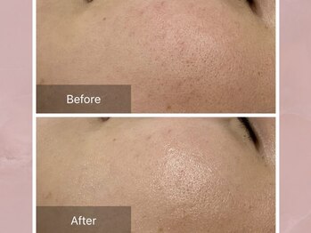 ステラルーテ(Stella lute)/ハーブピーリング 1回