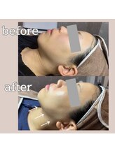 ベルフォルム(Belle Forme)/小顔フェイシャル