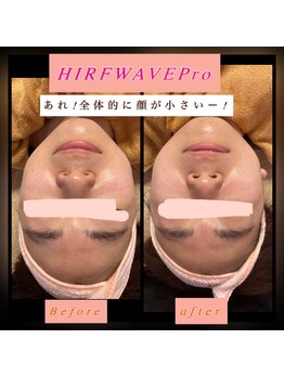 ティアメディカル(Tia Medical)/HIRFWAVEPro