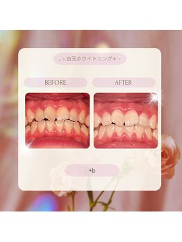 プラスビーセルフ(+b self)/ホワイトニングビフォーアフター