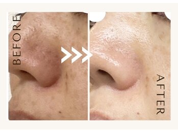 小顔フェイスラボ 鈴鹿店(小顔FaceLabo.)/◆毛穴の黒ずみ・汚れ改善◆