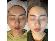 毛穴黒ずみ・ニキビ・シミケアなど肌の悩みに徹底アプローチ♪