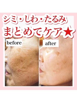 ホリシア 博多(HORISHIA)/ララピール/毛穴/ニキビケア