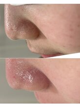 ハクビューティー(HAKU BEAUTY)/毛穴黒ずみ撃退