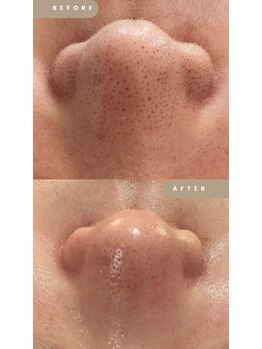 メイクス(Makes)/毛穴洗浄+フェイシャルワックス