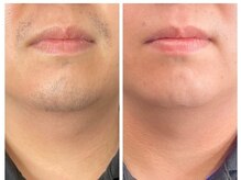 エルマナ(HERMANA)/ヒゲ脱毛・メンズ脱毛・VIO脱毛