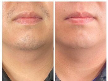 エルマナ(HERMANA)/ヒゲ脱毛・メンズ脱毛・VIO脱毛