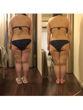 グラン ジュテ/筋膜ラジオ波ンド5回