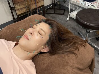 ビースタイル(B-style)/【美容鍼灸】電気美容鍼灸施術