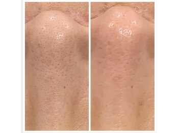 ケイ(Kei)/肌質改善コース☆before/after