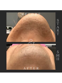 ルルマル(lulumalu)/髭脱毛