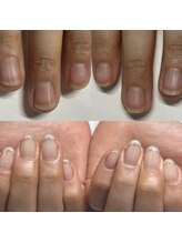 マニュコクーン(ManuCocoon)/爪育成　深爪　巻き爪　大阪市