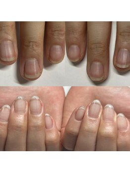 マニュコクーン(ManuCocoon)/爪育成 深爪 巻き爪 大阪市